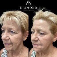 Facial Fillers Midtown ico