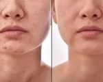 Best Spa Treatments for Scar Healing: Effective Care for Beautiful Skin