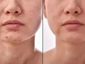 Best Spa Treatments for Scar Healing: Effective Care for Beautiful Skin