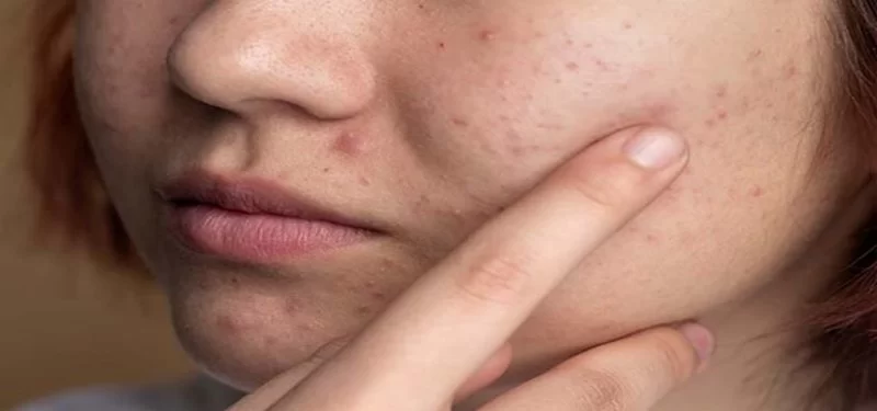 Best Spa Treatments for Healing Acne Scars: What Really Works