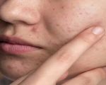 Best Spa Treatments for Healing Acne Scars: What Really Works